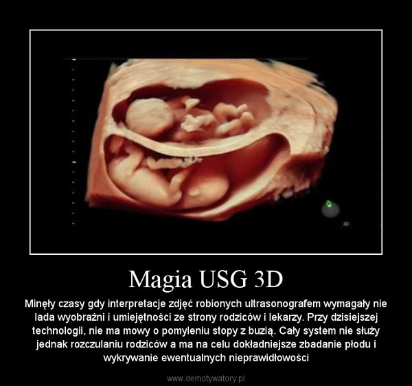 Magia USG 3D – Minęły czasy gdy interpretacje zdjęć robionych ultrasonografem wymagały nie lada wyobraźni i umiejętności ze strony rodziców i lekarzy. Przy dzisiejszej technologii, nie ma mowy o pomyleniu stopy z buzią. Cały system nie służy jednak rozczulaniu rodziców a ma na celu dokładniejsze zbadanie płodu i wykrywanie ewentualnych nieprawidłowości 