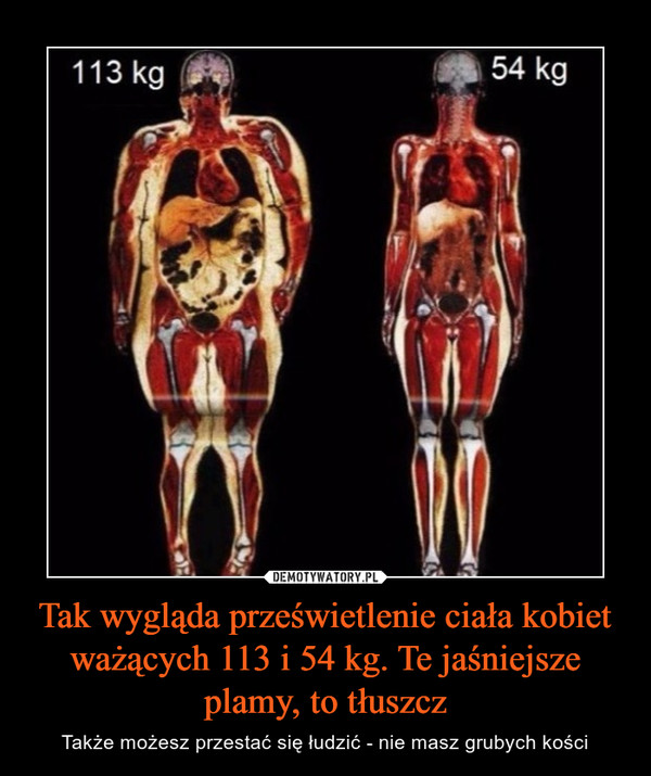 Tak wygląda prześwietlenie ciała kobiet ważących 113 i 54 kg. Te jaśniejsze plamy, to tłuszcz – Także możesz przestać się łudzić - nie masz grubych kości 