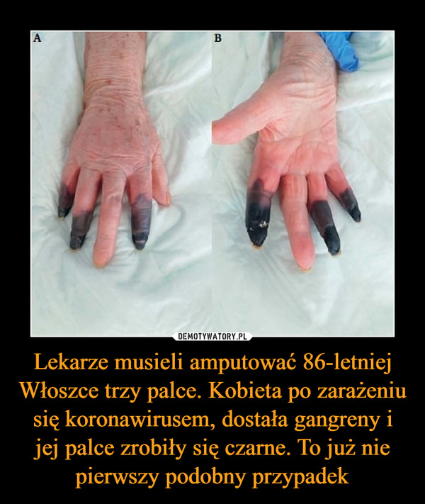 Lekarze musieli amputować 86-letniej Włoszce trzy palce. Kobieta po zarażeniu się koronawirusem, dostała gangreny i jej palce zrobiły się czarne. To już nie pierwszy podobny przypadek –  
